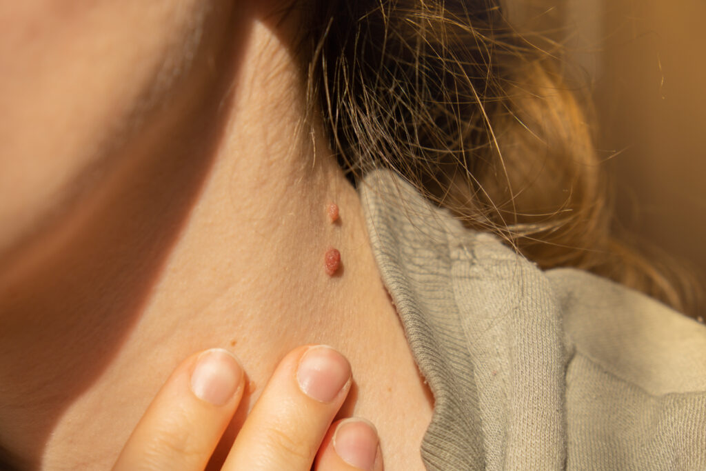 can you use wart remover on skin tags