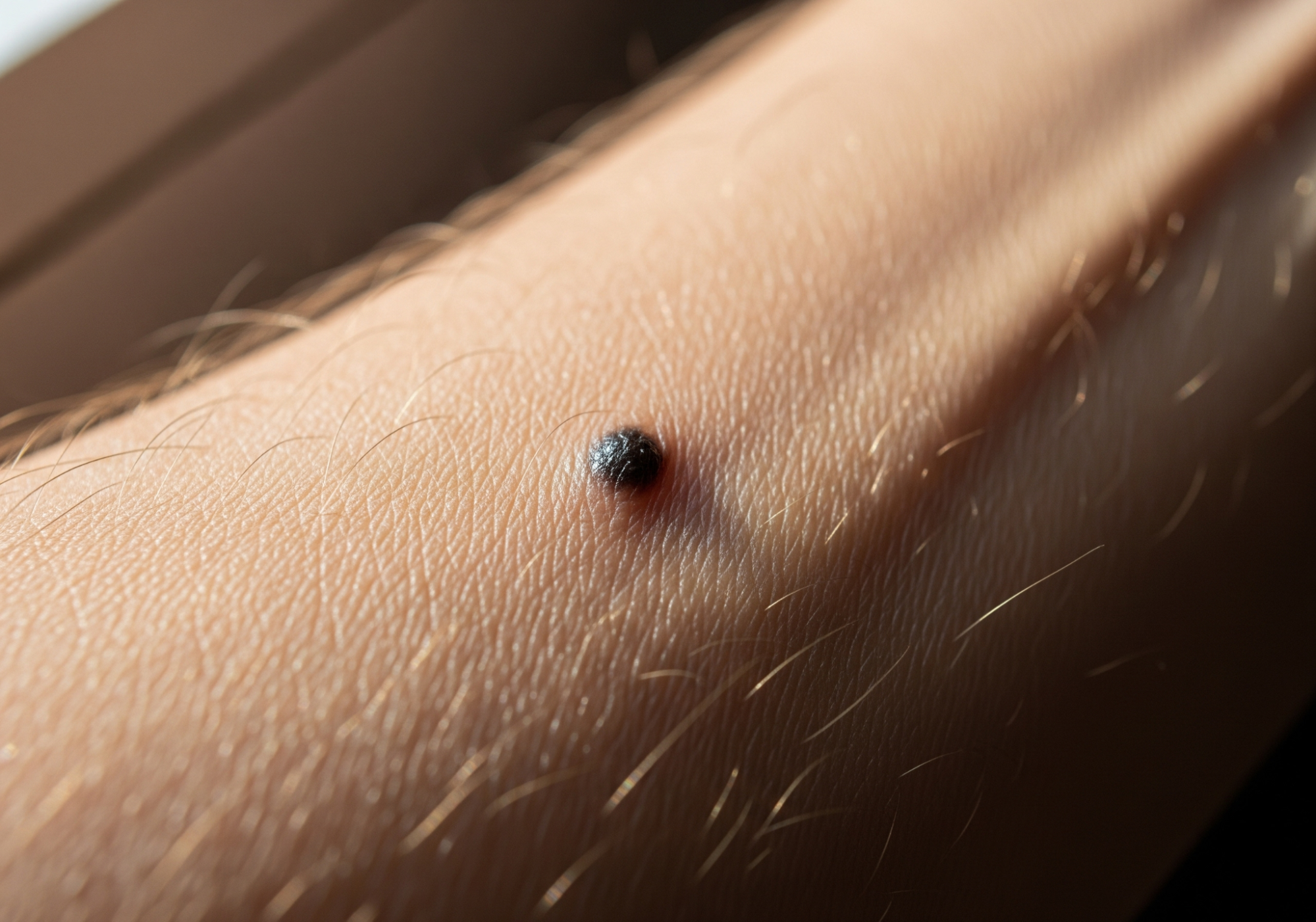 mole on arm