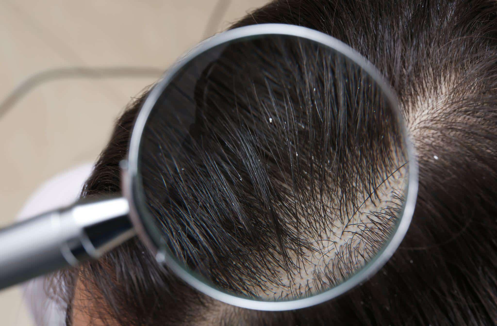 child with nits in hair
