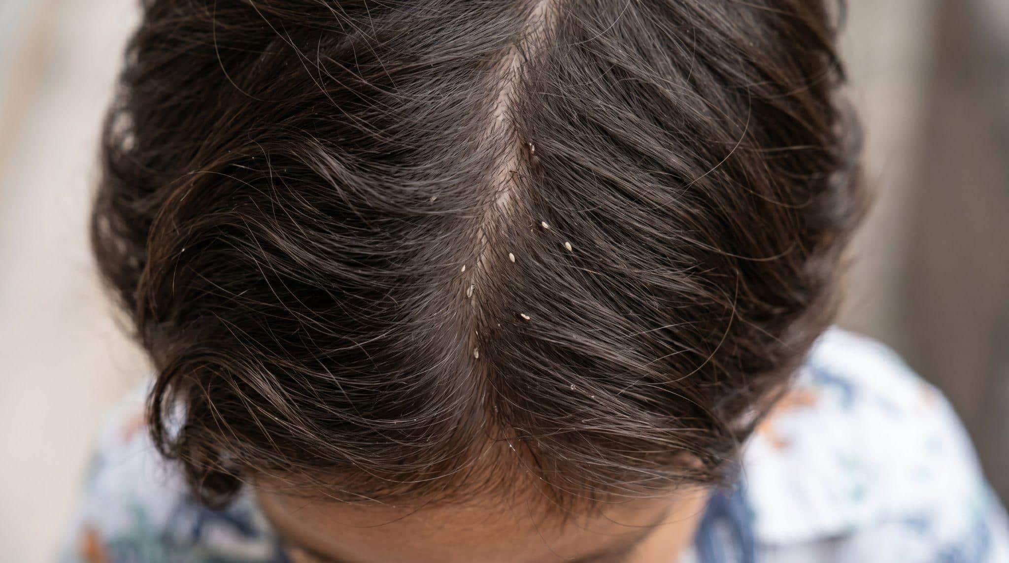 child with nits in hair