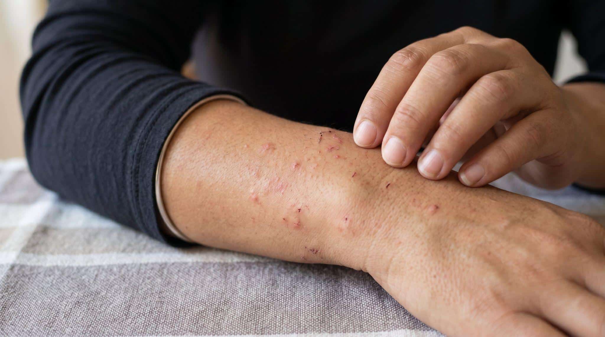 person with itchy rashes on wrist area
