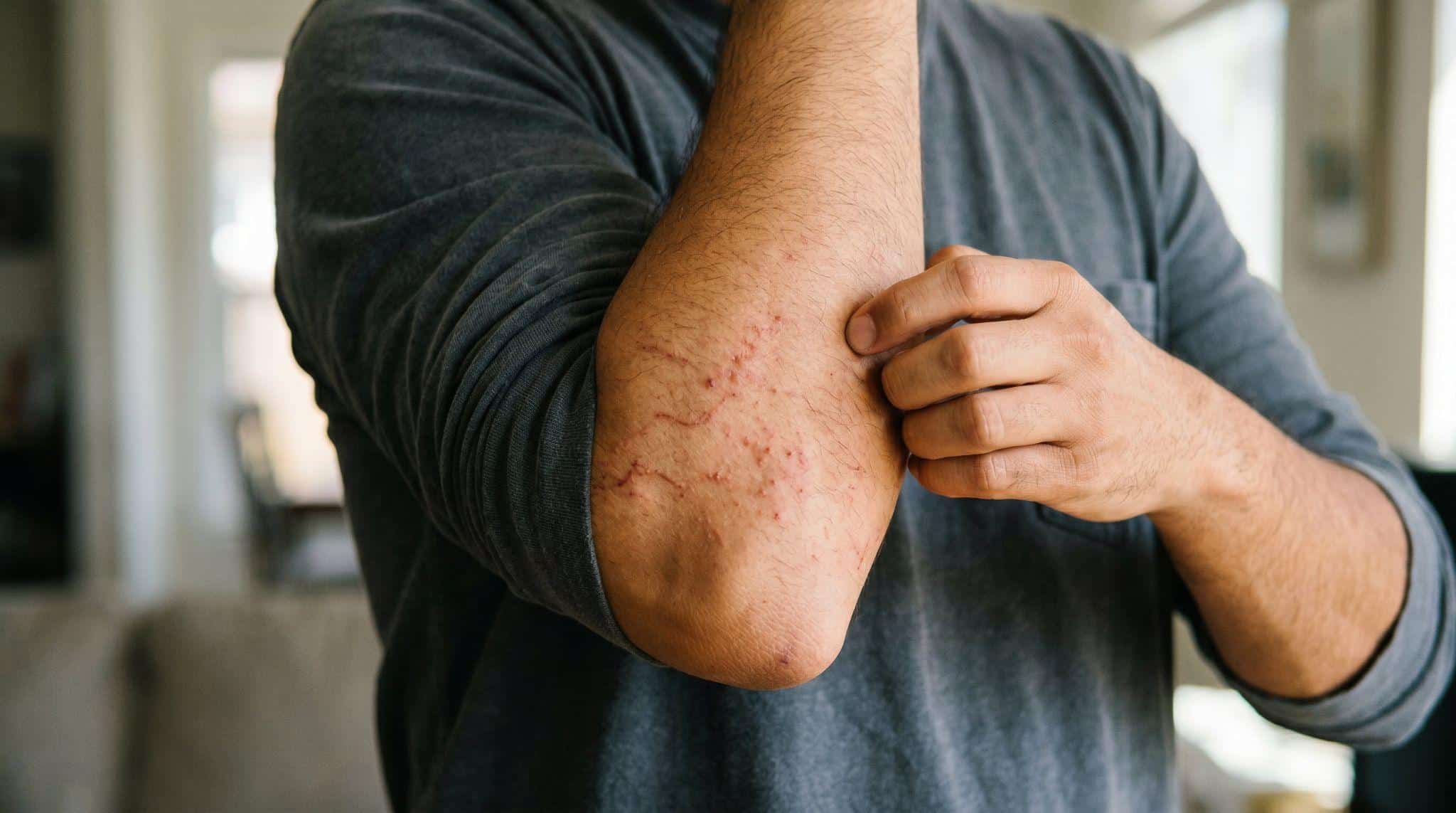 man with rash around elbow