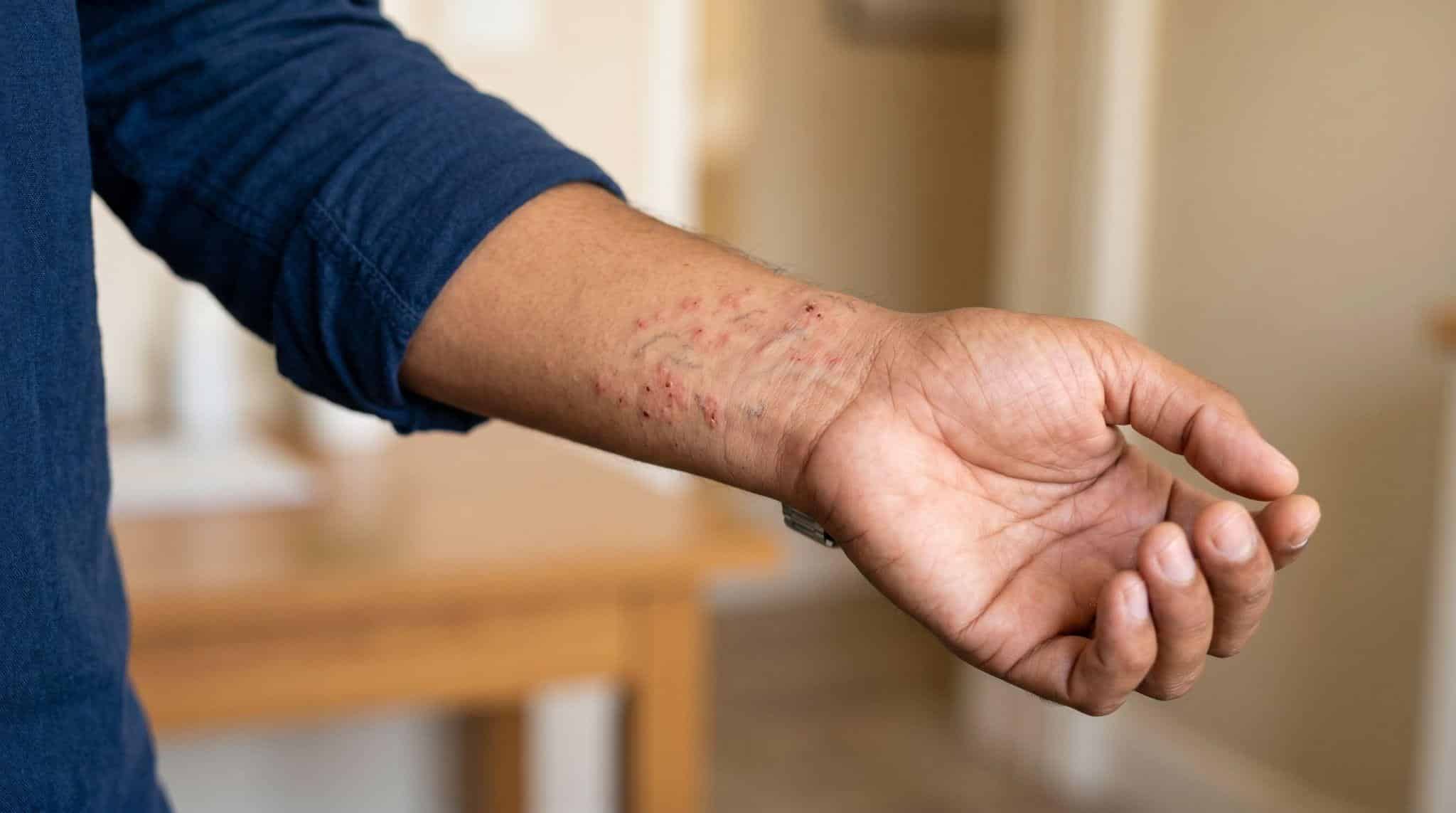 man with rashes on wrist, symbolizing the relief provided by a scabies doctor near me