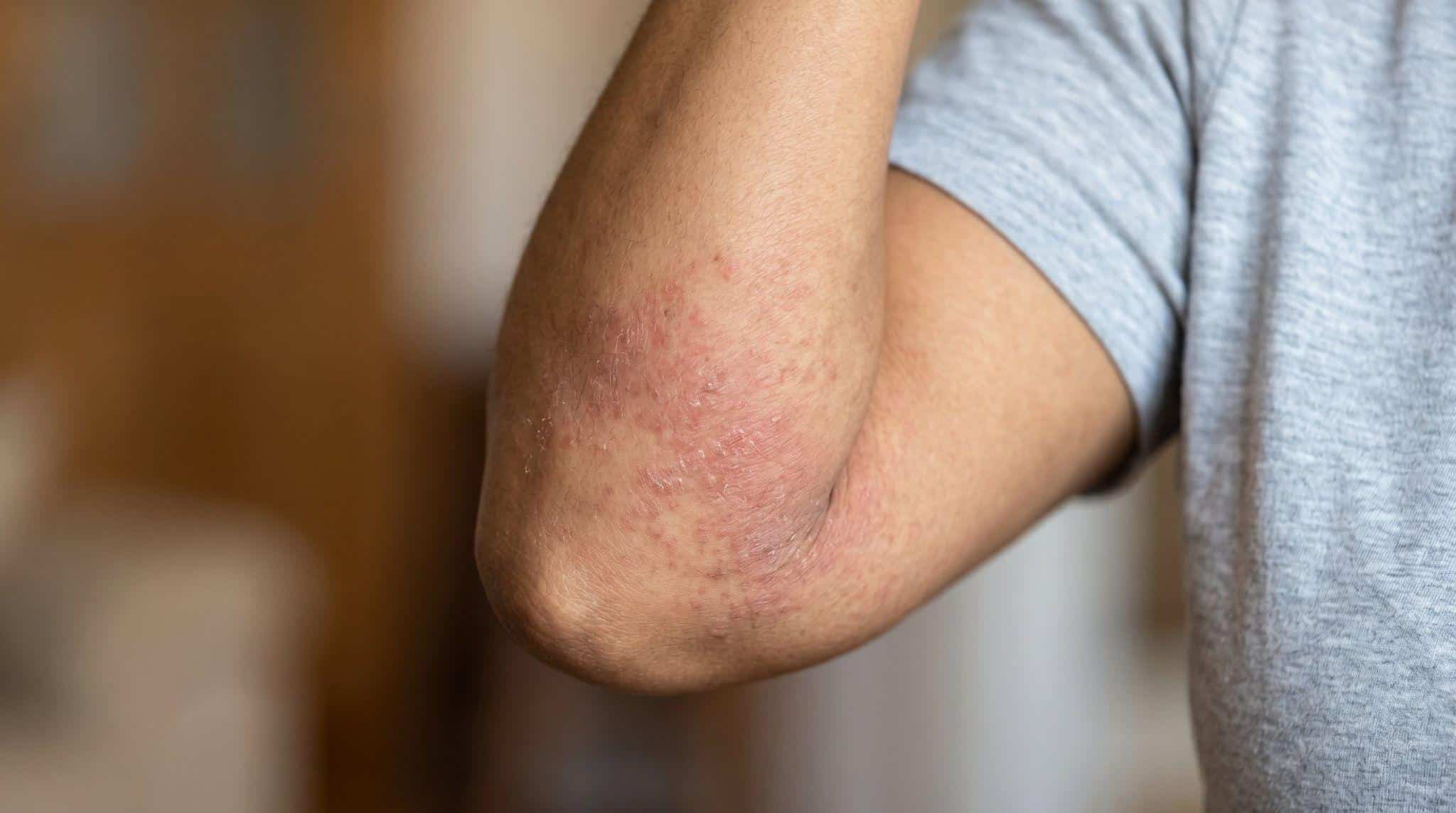 person with rashes near elbow