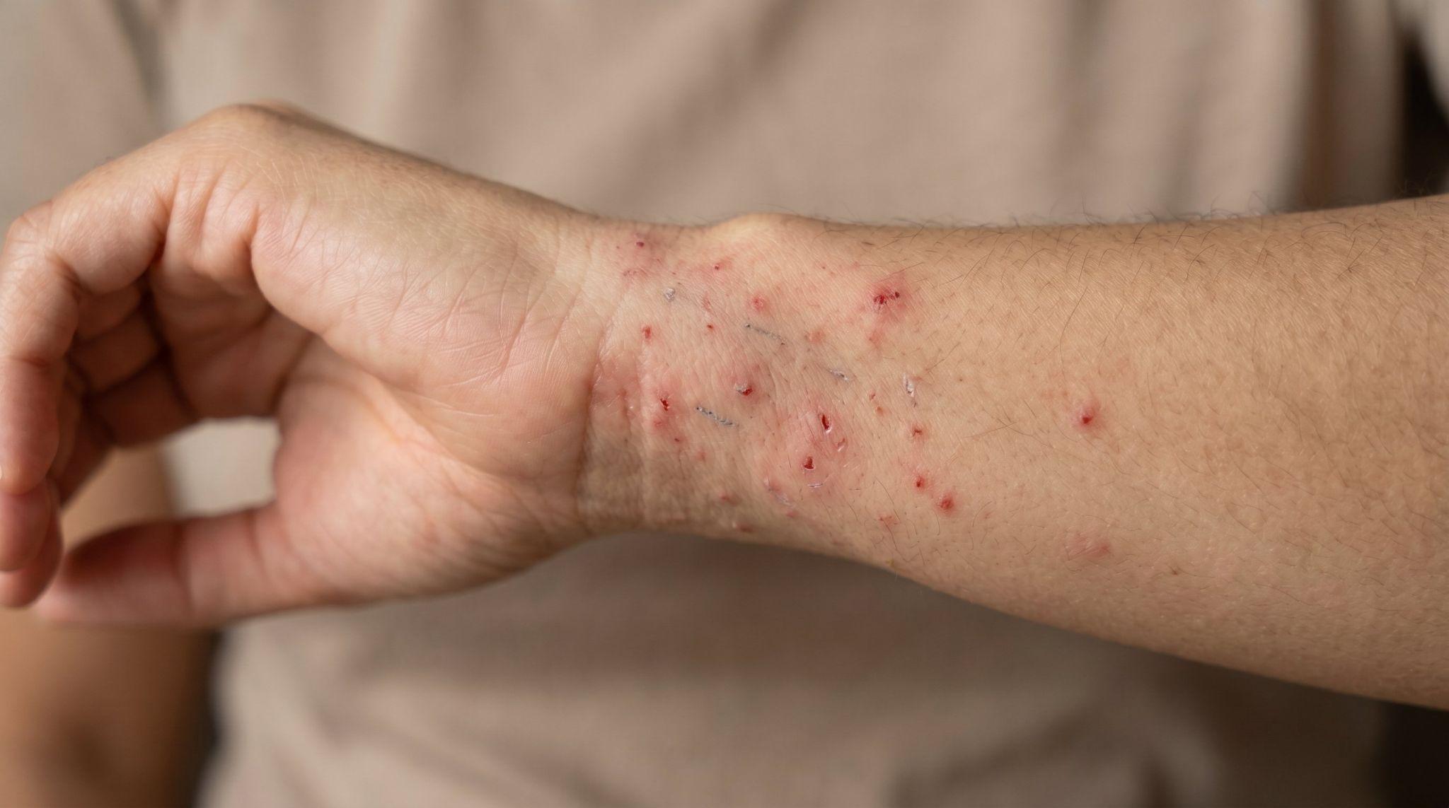 man with itchy rashes on arm
