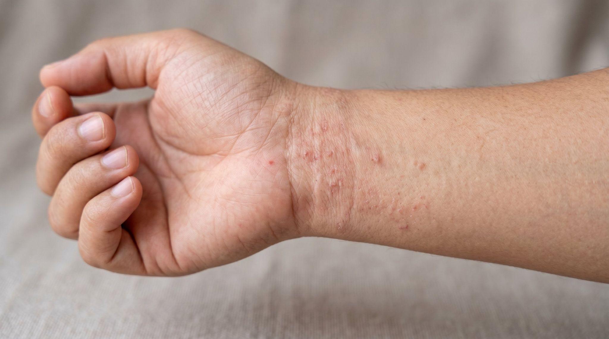 person with rashes on wrist