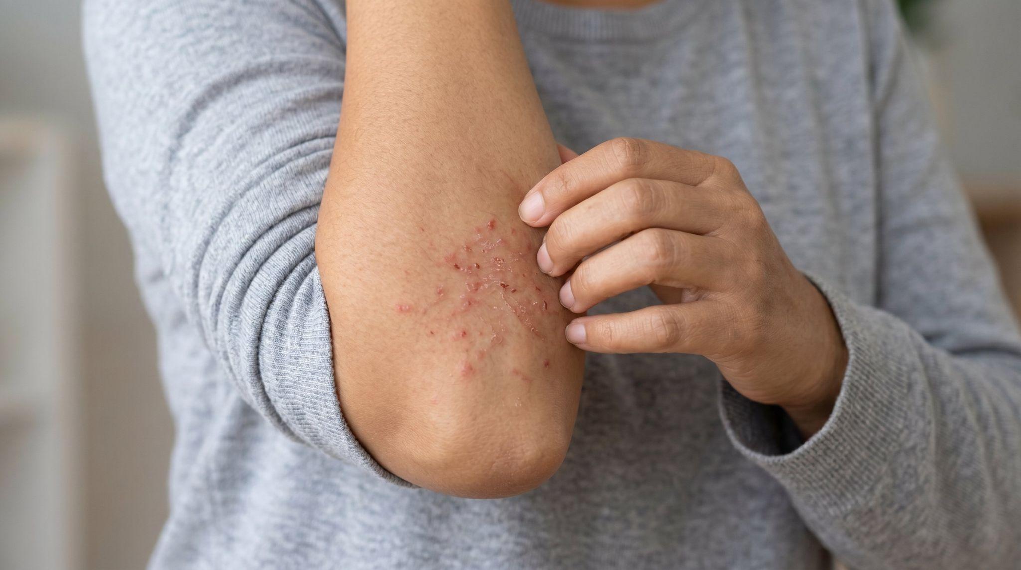 person scratching elbow area