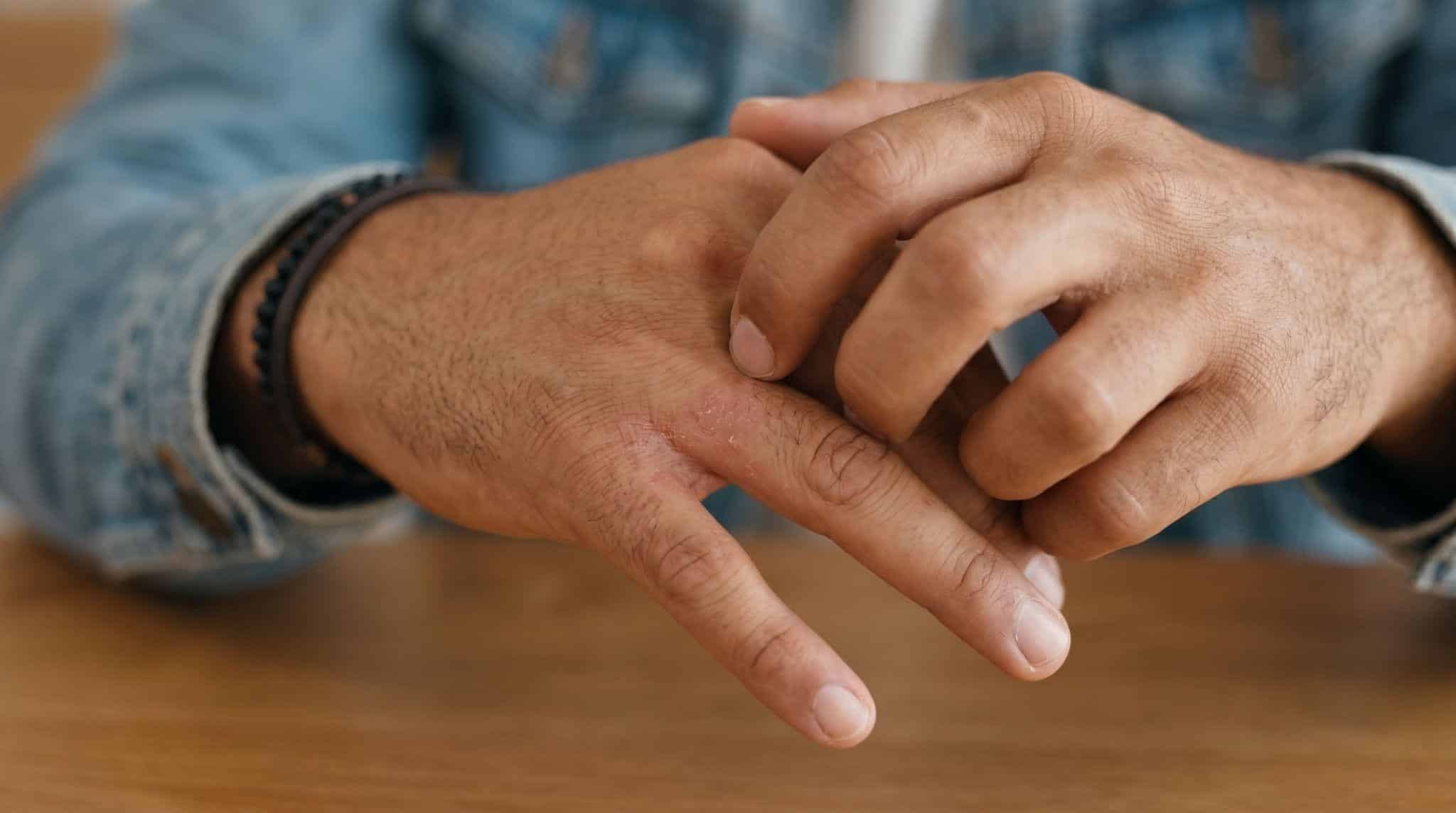 man scratching itchy hands
