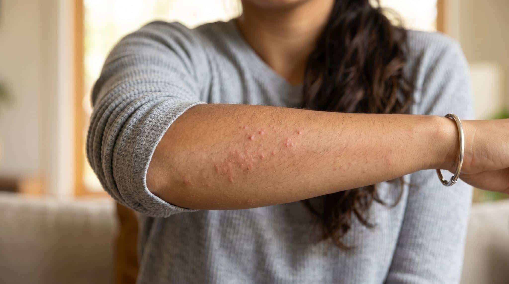 woman with rash on arm