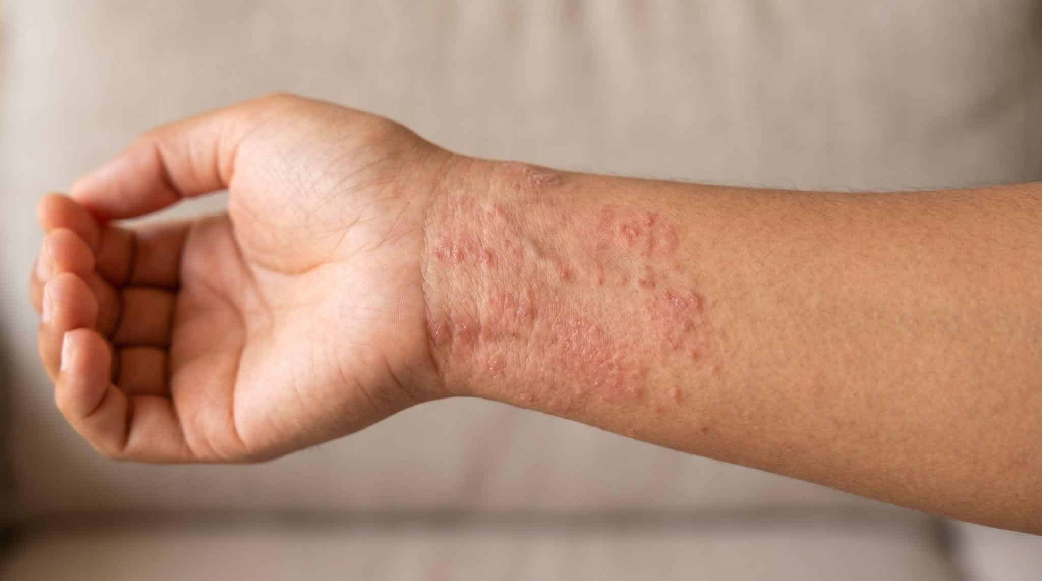 arm with rashes