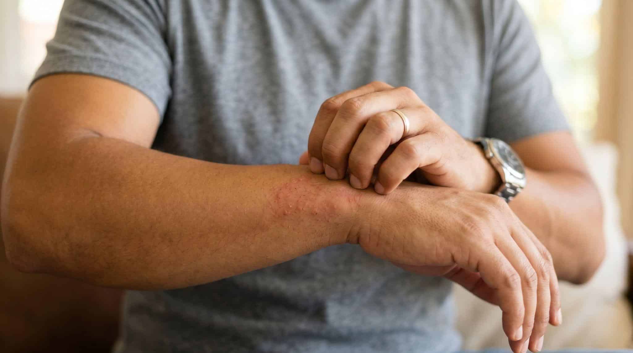 man with itchy arm