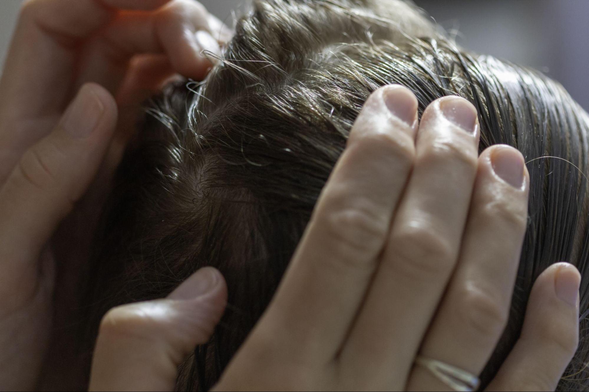 Close-up scalp inspection for lice eggs removal, with hair carefully parted to check for nits and signs of head lice.