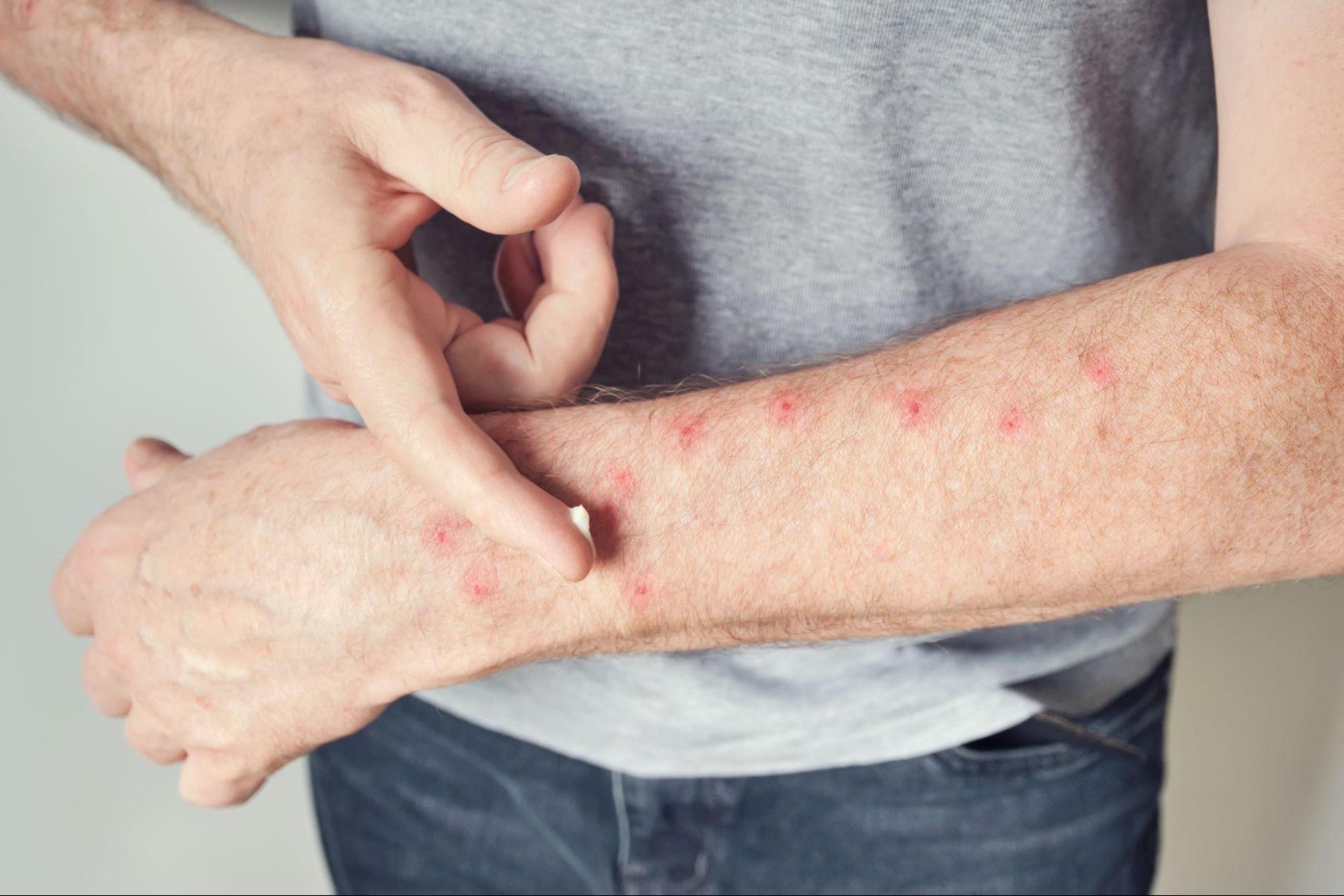 Scabies Itch Treatment: Effective Ways to Relieve Itching and Treat Scabies