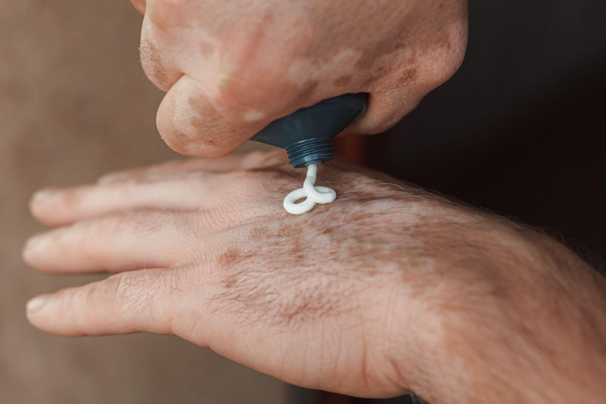 Scabies Mite Treatment: Symptoms, Medications, and Prevention Tips