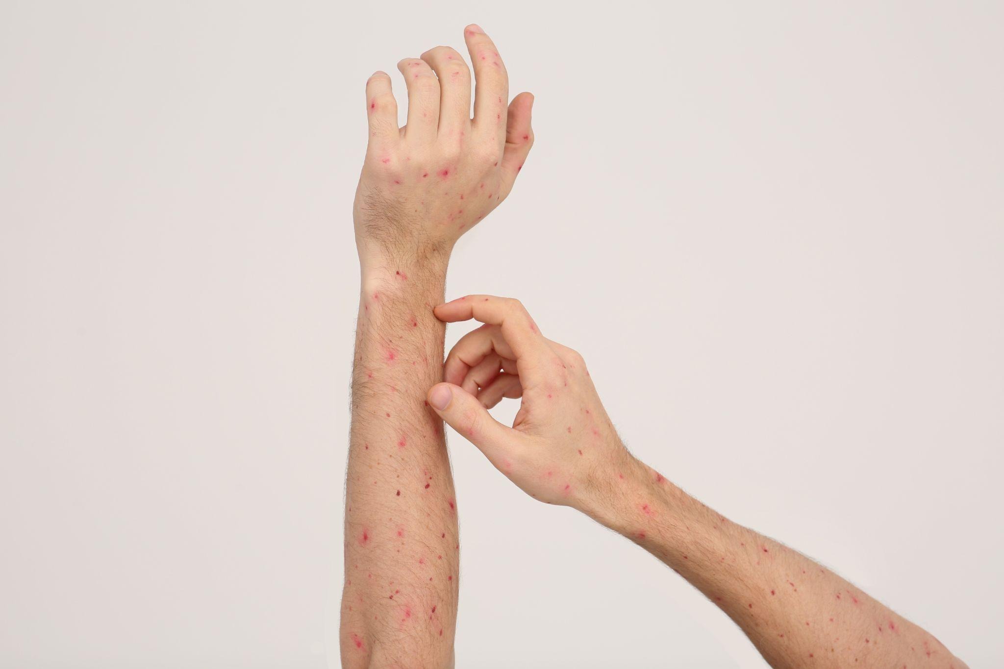 Person scratching red, irritated bumps on the arms and hands while seeking scabies mite treatment.