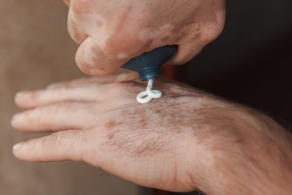 Scabies Mite Treatment: Symptoms, Medications, and Prevention Tips