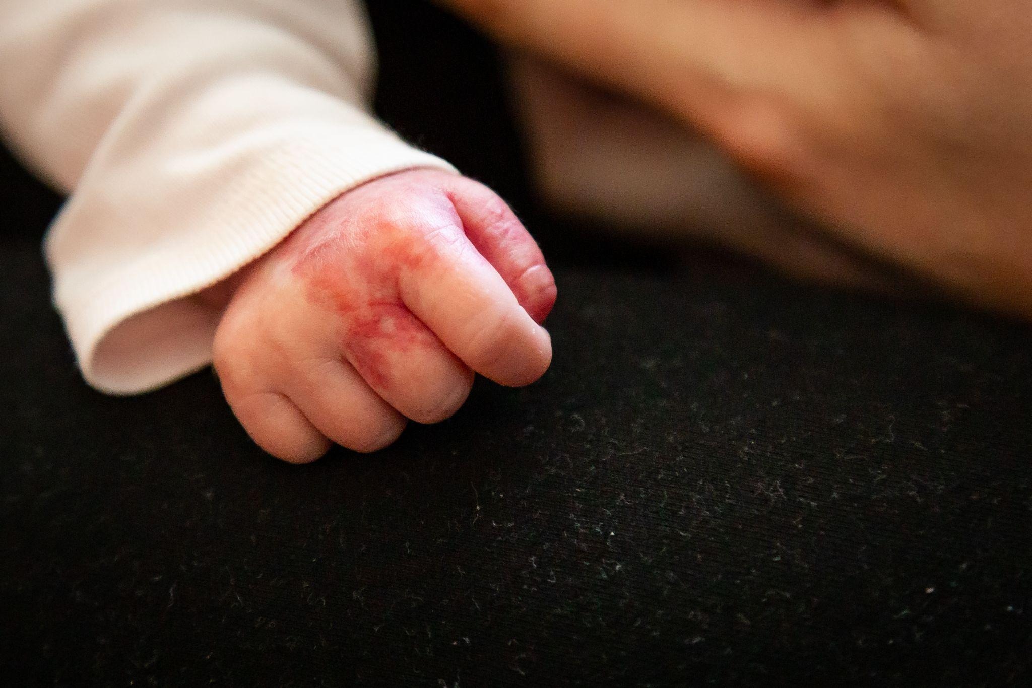 Infant’s hand with red, irritated skin that may require evaluation before starting scabies mite treatment.
