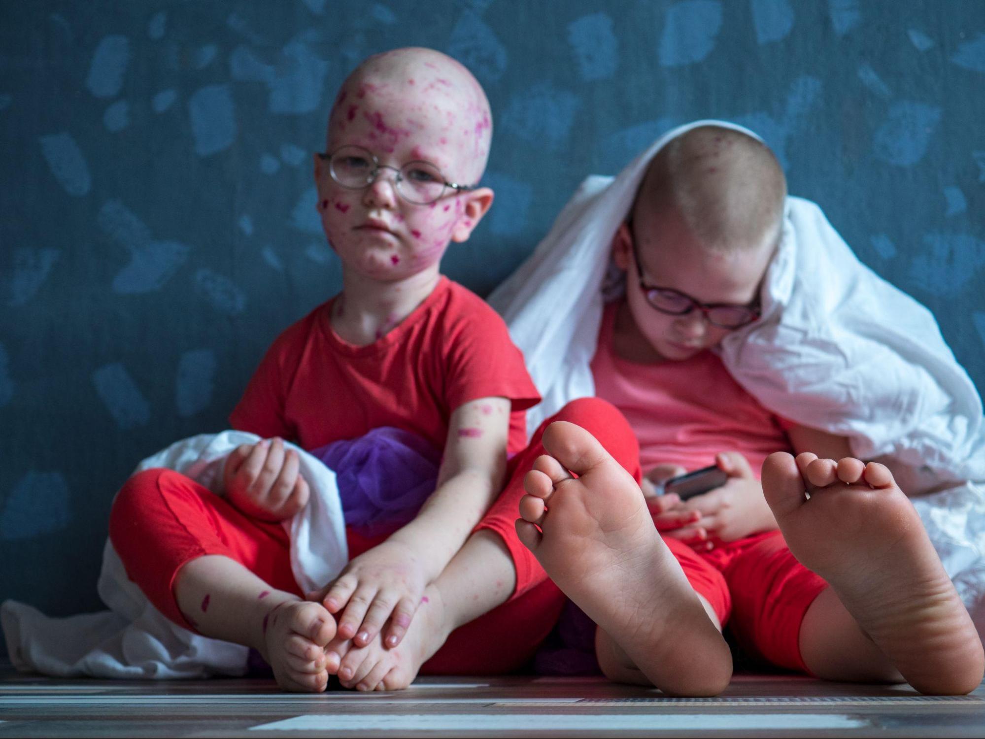 Two children sitting together with visible skin rashes, illustrating why coordinated scabies treatment for family members may be needed.
