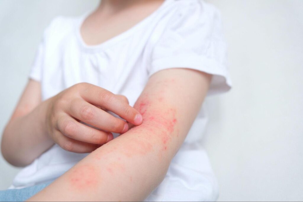 Child scratching an irritated red rash on the arm, highlighting symptoms that may lead families to seek scabies treatment for family members.