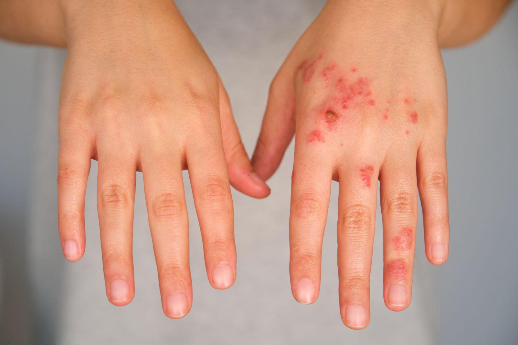 Close-up of a child’s hands with a red, irritated rash, showing skin symptoms that may prompt scabies treatment for family members. 